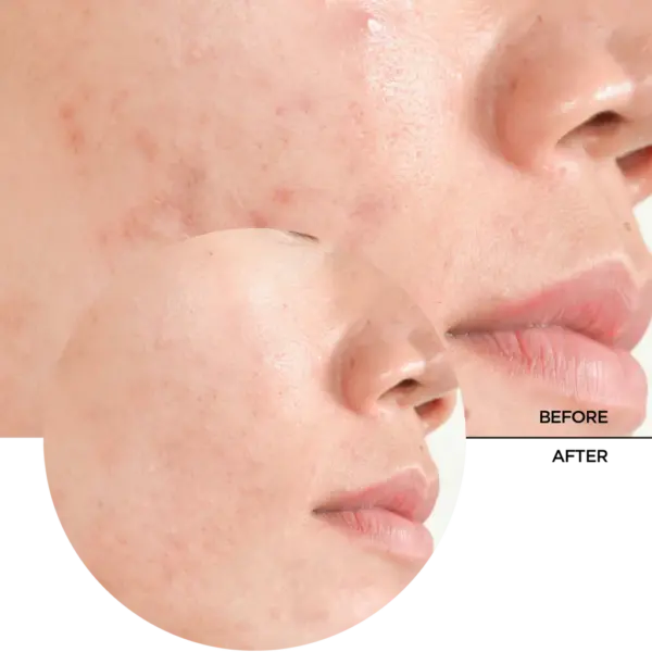 Revox Just Salicylic Acid 2% Peeling Solution 30ml